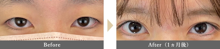 二重整形の症例写真 Before After 1カ月後