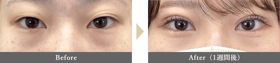 二重整形の症例写真 Before After 1週間後