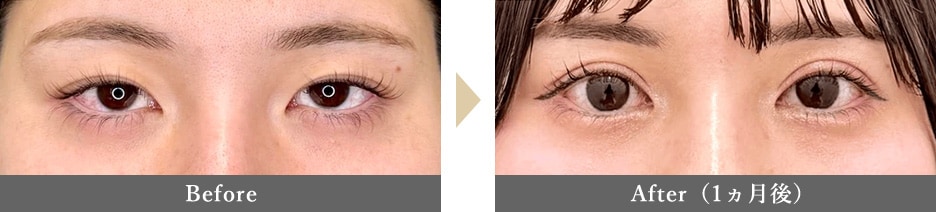 二重整形の症例写真 Before After 1カ月後