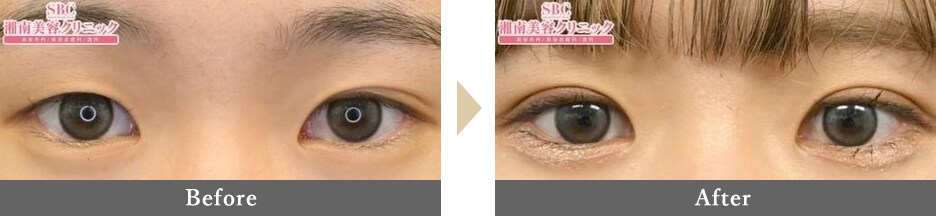 二重整形の症例写真 Before After 1カ月後