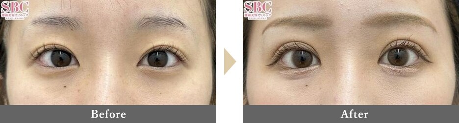 二重整形の症例写真 Before After 1ヶ月後