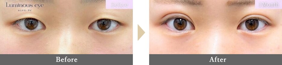 二重整形の症例写真 Before After 3カ月後