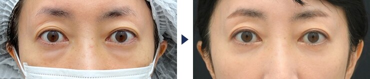 菅原佑太医師のクマ取り症例