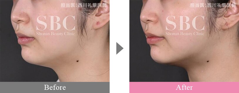 横浜エリアのハイフの症例写真2