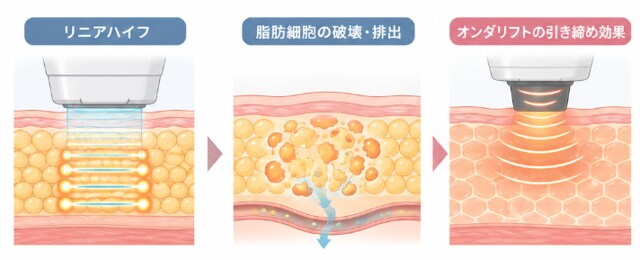 脂肪溶解リニアハイフとオンダリフトの併用イメージ