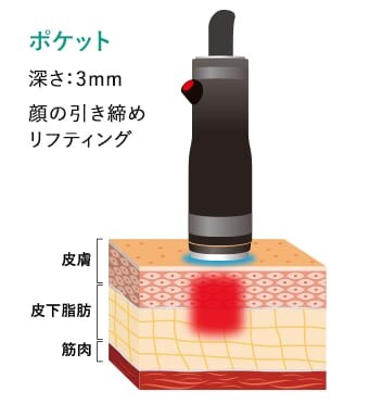 シャロー
                    