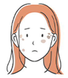 頬に現れる老人性色素斑のイラスト