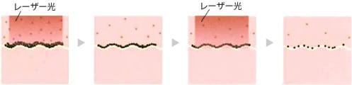 レーザー光でメラニン色素を少しずつ破壊する仕組み