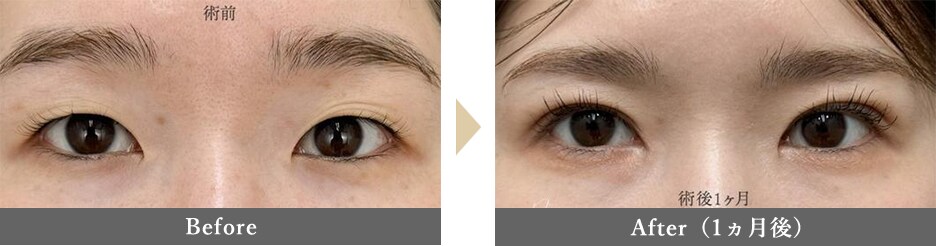 目頭切開の症例写真 Before After 1ヵ月後
