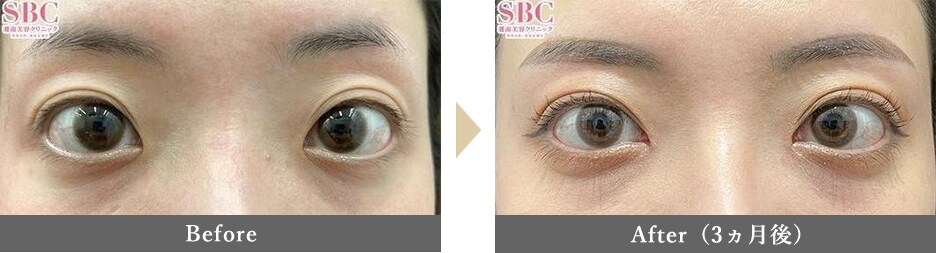 目頭切開の症例写真 Before After 3ヵ月後