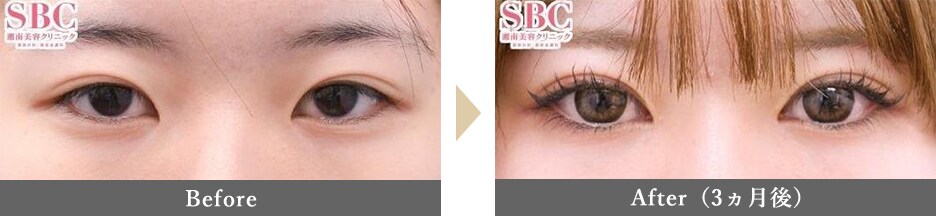 目頭切開の症例写真 Before After 3ヵ月後