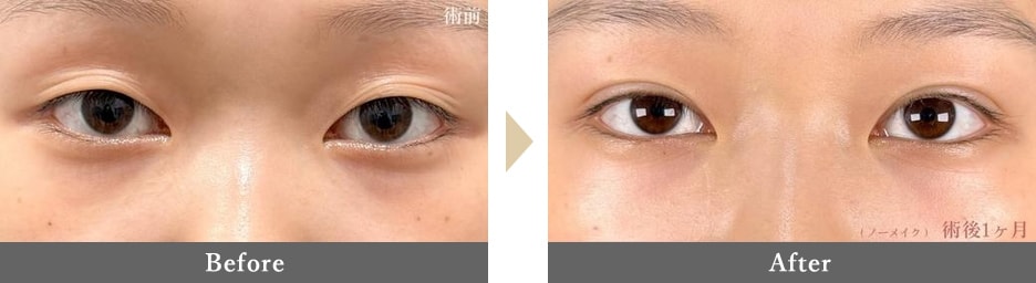 二重整形の症例写真 Before After 1カ月後