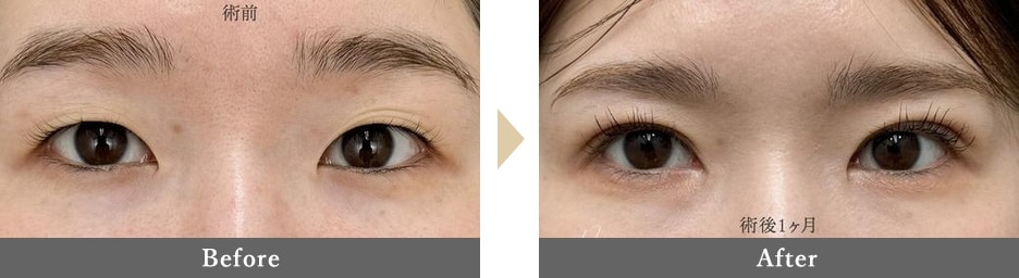 二重整形の症例写真 Before After 1ヶ月後