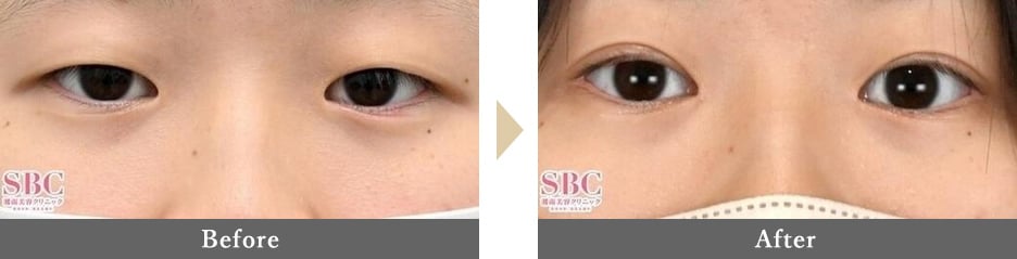 二重整形の症例写真 Before After 3カ月後