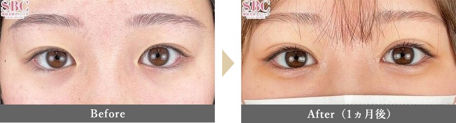 目頭切開の症例写真 Before After 1ヵ月後