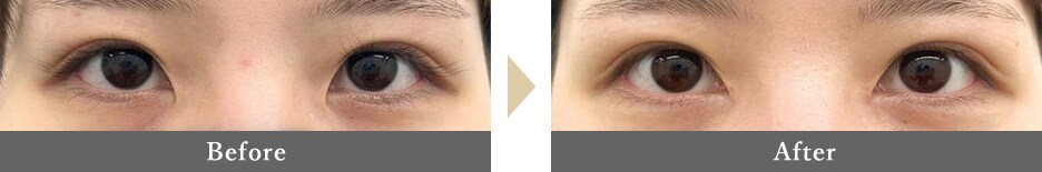 目頭切開の症例写真 Before After 3ヵ月後