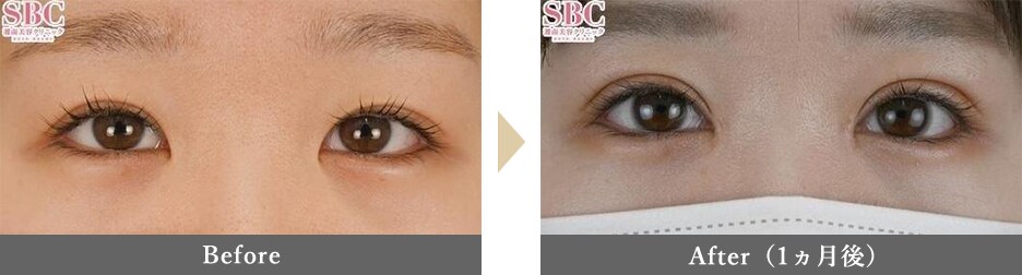 目頭切開の症例写真 Before After 1ヵ月後