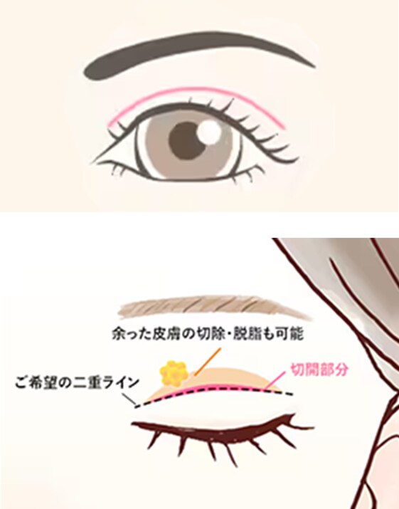 全切開二重術