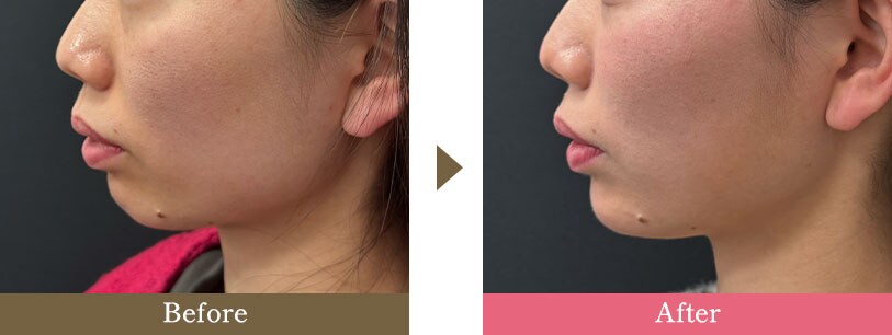 エラボトックスの症例写真 Before After