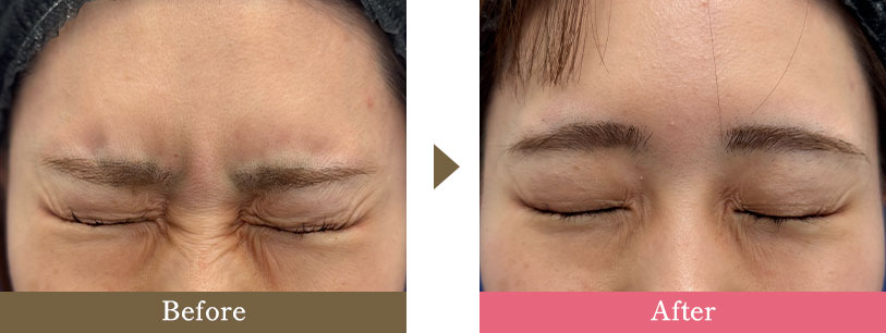 額ボトックスの症例写真 Before After
