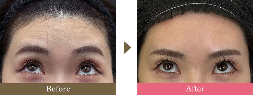 額ボトックスの症例写真 Before After