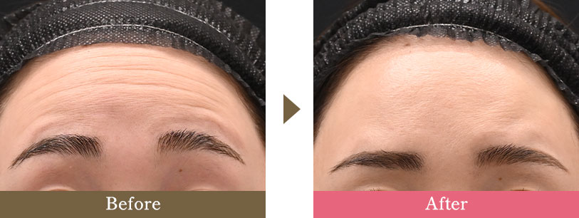 額ボトックスの症例写真 Before After