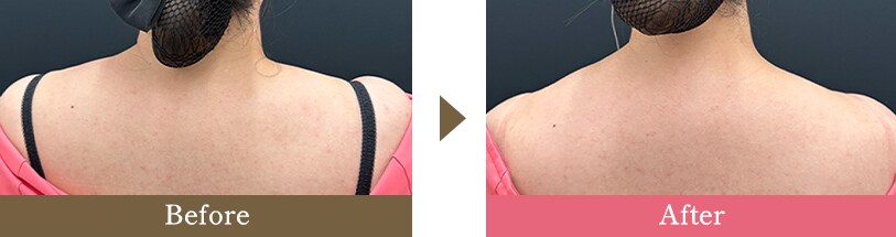 肩ボトックスの症例写真 Before After
