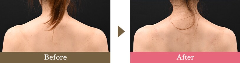 肩ボトックスの症例写真 Before After