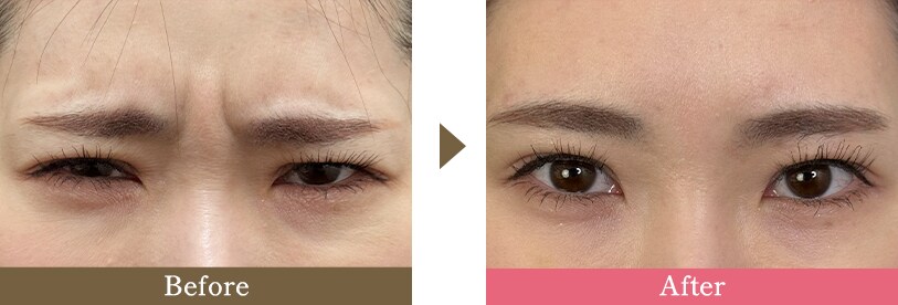眉間ボトックスの症例写真 Before After