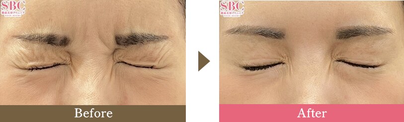 目尻ボトックスの症例写真 Before After