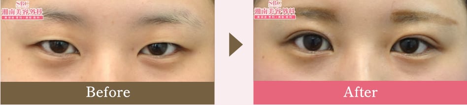 自然癒着セット(まぶたの脂肪取り)