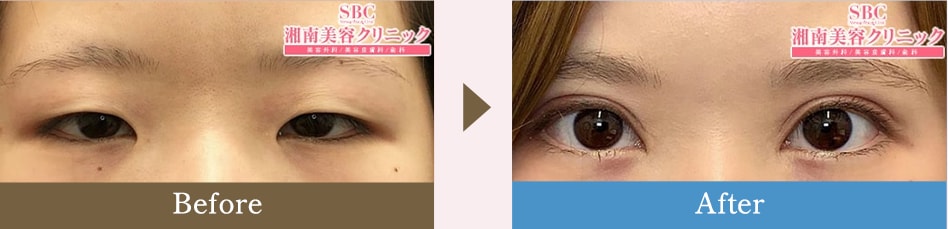 全切開法二重術