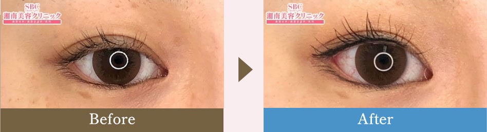 眼瞼下垂