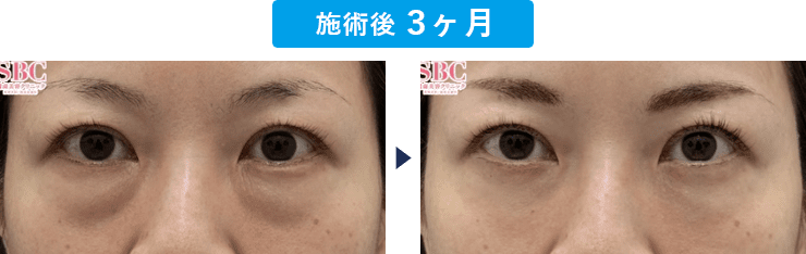 吉田公人医師のクマ取り症例