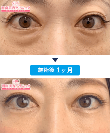 村上隆英医師のクマ取り症例