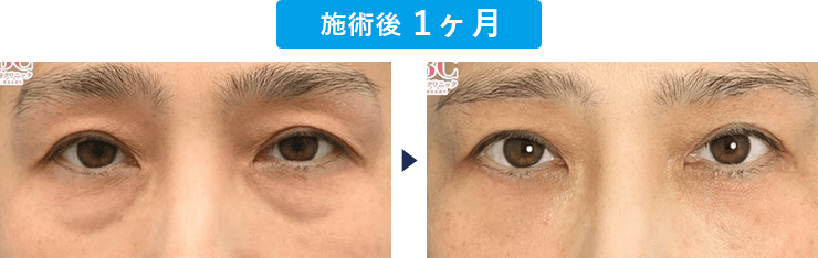 野口祥世医師のクマ取り症例