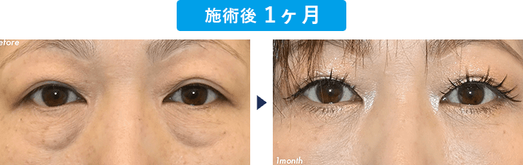 田村暢章医師のクマ取り症例