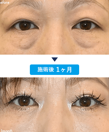 田村暢章医師のクマ取り症例