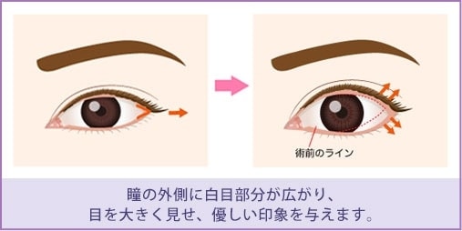 瞳の外側に白目部分が広がり、目を大きく見せ、優しい印象を与えます