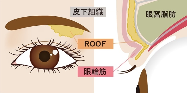 ROOF・眼輪筋・皮下組織・眼窩脂肪の位置関係を示した目元の断面図