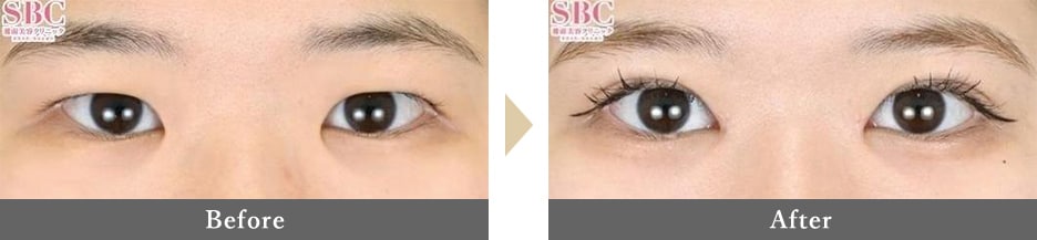 生まれつき風のナチュラルで明るい瞳へ