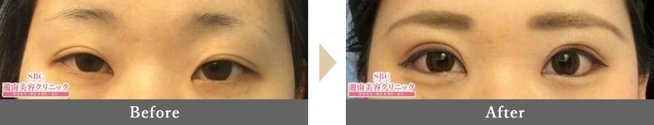 複合施術でナチュラルなデカ目効果