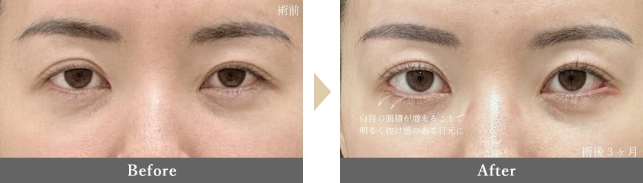 目尻切開+タレ目形成の併用で、抜け感のある目元へ