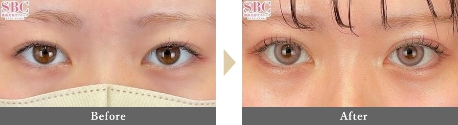二重整形の症例写真 Before After 1ヶ月後
