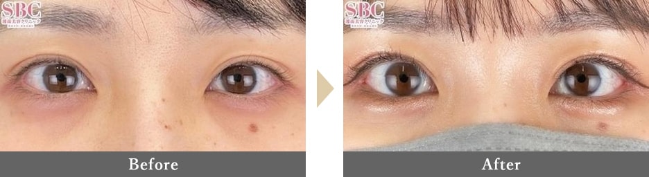 二重整形の症例写真 Before After 1ヶ月後