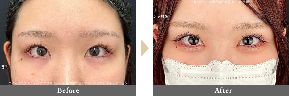 二重整形の症例写真 Before After 3ヶ月後
