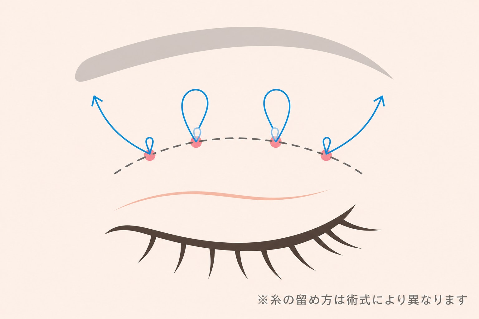 二重整形 埋没法のイメージ