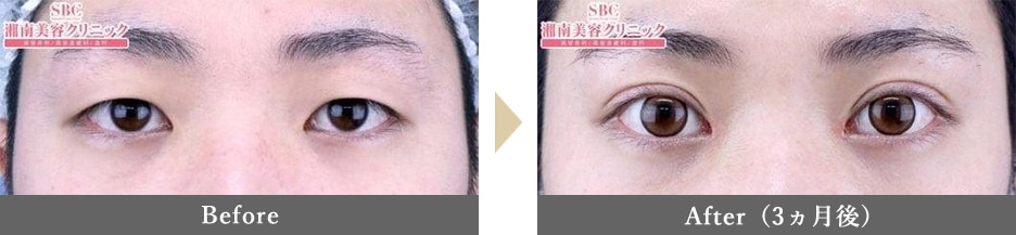 目頭切開の症例写真 Before After 3ヵ月後