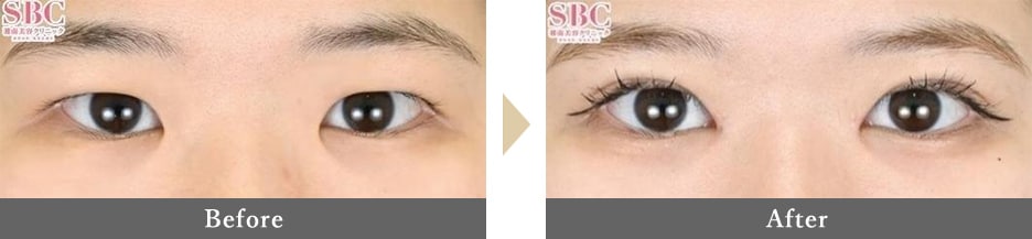 目頭切開の症例写真 Before After
