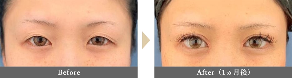目頭切開の症例写真 Before After 1ヵ月後